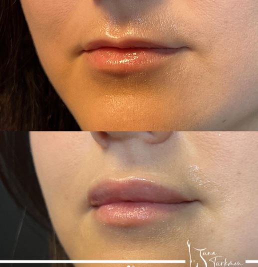 lip filler